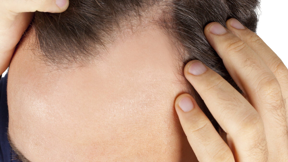 What Are the Types of Hair Loss in Men?