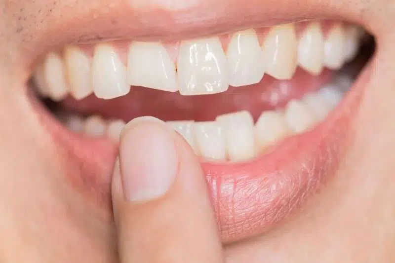 What Are The Treatment Options Available For Cracked Teeth?