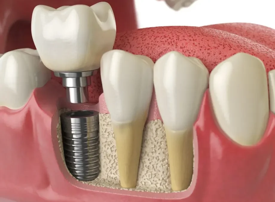 Restoring Your Smile With Confidence Through Implant Dentistry