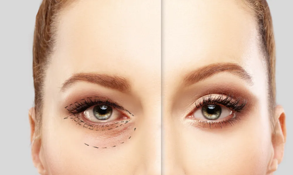 Discussing The Various Factors That Influence The Upper Blepharoplasty Cost